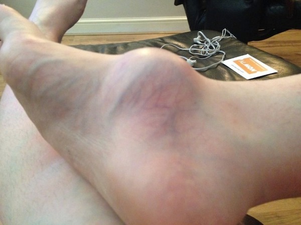 Le pied d'une femme était enflé pendant des années, puis elle a finalement consulté un médecin pour savoir pourquoi