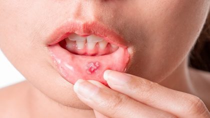 Les huit infections buccales les plus courantes