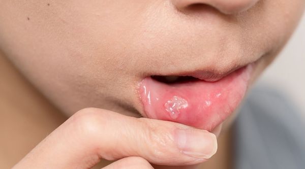 Les huit infections buccales les plus courantes