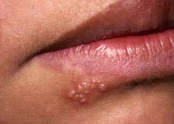 Maladies virales et bactériennes de la muqueuse buccale
