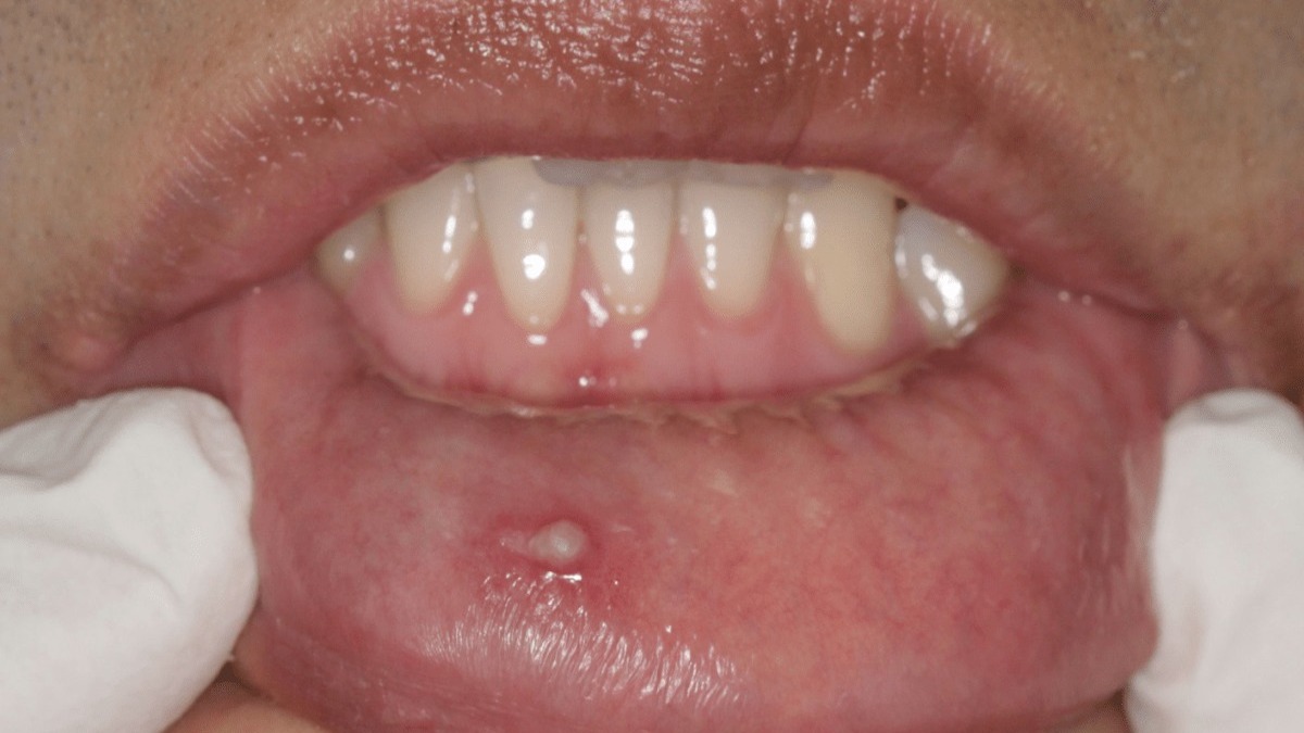 Maladies virales et bactériennes de la muqueuse buccale