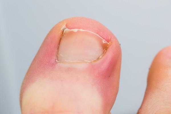 Ongles incarnés : qu'est-ce que c'est, pourquoi ils apparaissent et comment les guérir