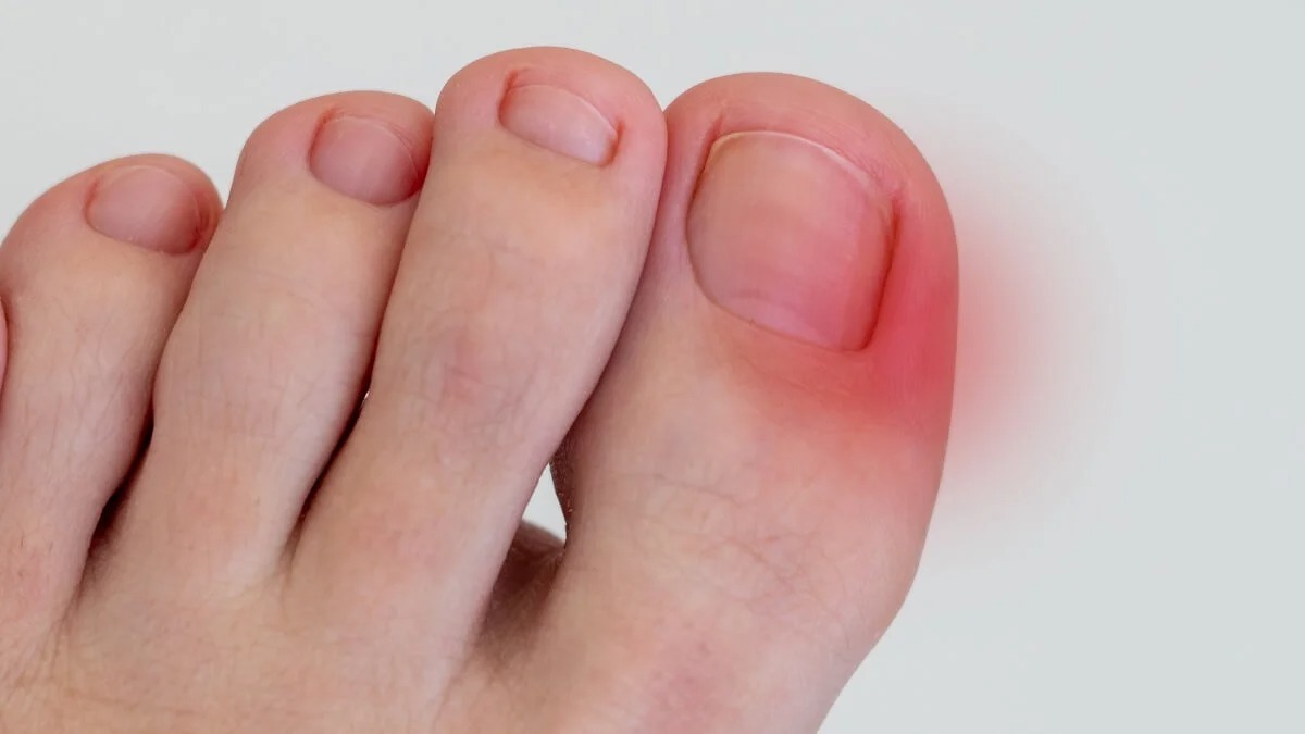 Ongles incarnés : qu'est-ce que c'est, pourquoi ils apparaissent et comment les guérir