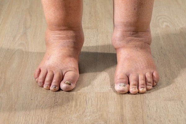 Pieds gonflés : 5 causes, traitements et remèdes maison