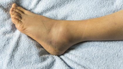 Pieds gonflés : 5 causes, traitements et remèdes maison