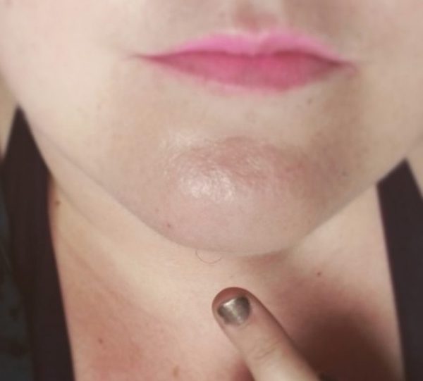 Pourquoi certaines femmes ont-elles des poils au menton et quel est le moyen le plus efficace de les éliminer ?