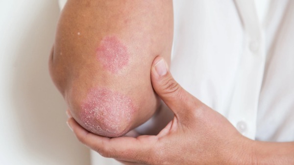 Psoriasis : causes, symptômes, diagnostic et traitements