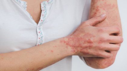 Psoriasis : causes, symptômes, diagnostic et traitements