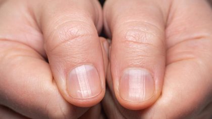 Ongles striés verticalement ? Principales causes et traitement recommandé