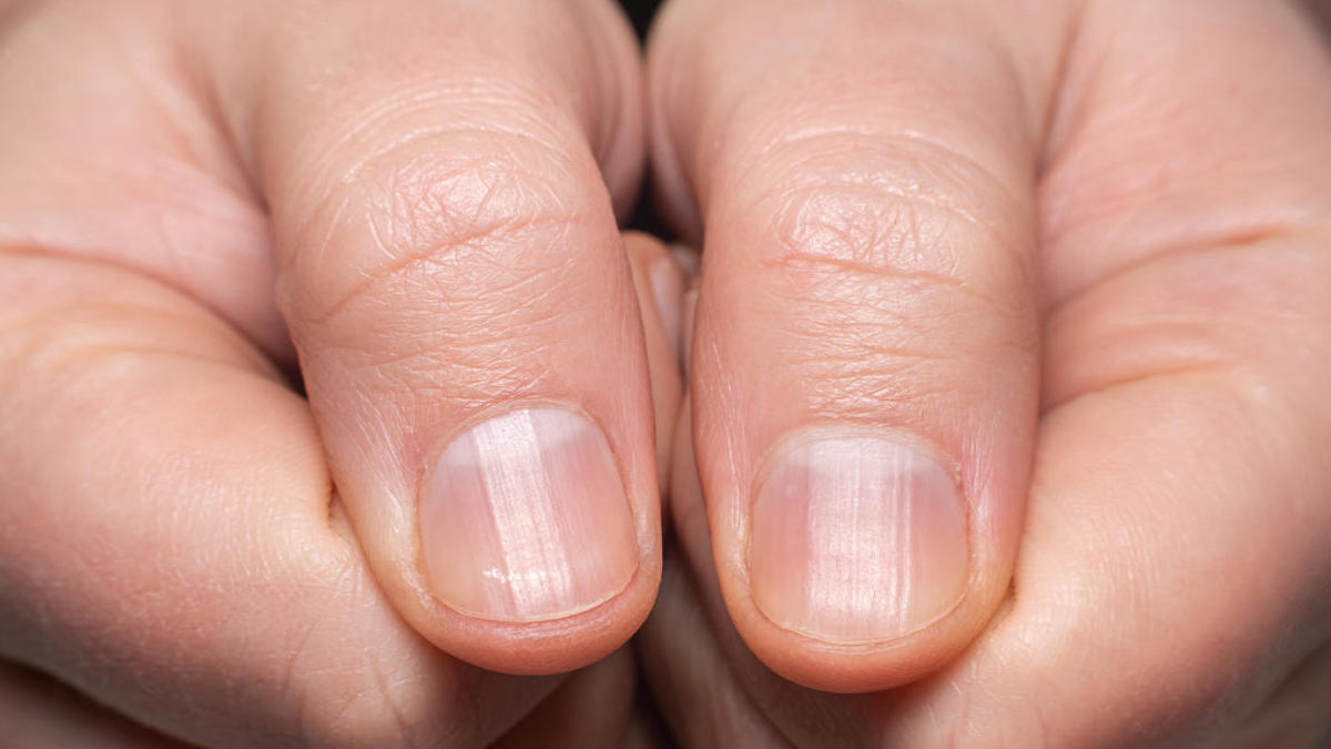 Ongles striés verticalement ? Principales causes et traitement recommandé