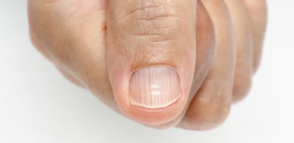 Ongles striés verticalement ? Principales causes et traitement recommandé
