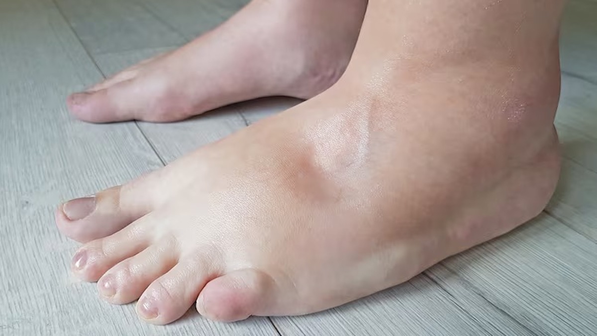 Quelle maladie provoque un gonflement, des démangeaisons et des brûlures des pieds ?