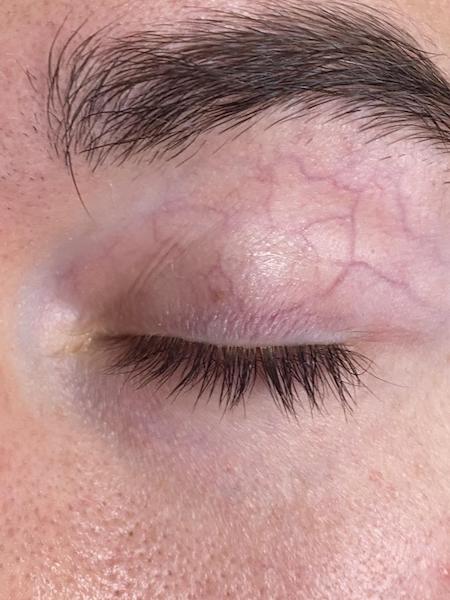 Quelles sont les causes des paupières veineuses et comment sont-elles traitées ?