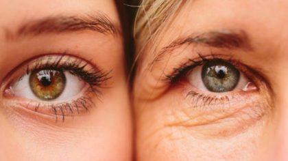 Quelles sont les causes des paupières veineuses et comment sont-elles traitées ?