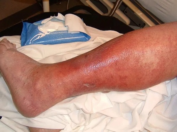 Symptômes et causes de la cellulite infectieuse