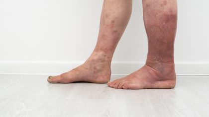 Symptômes et causes de la cellulite infectieuse