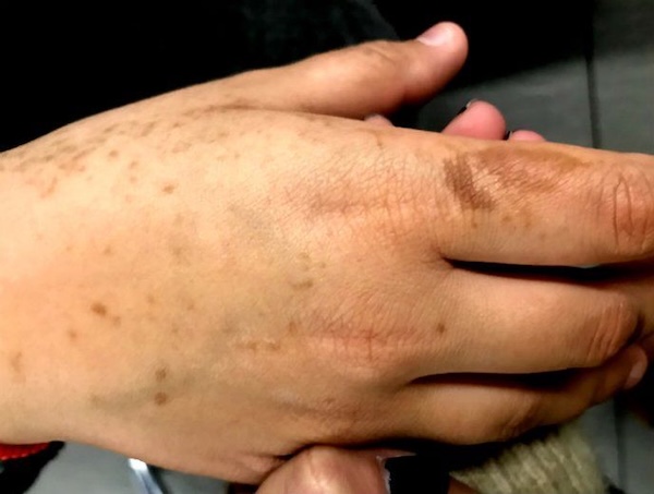 Taches sur les mains : causes et traitement
