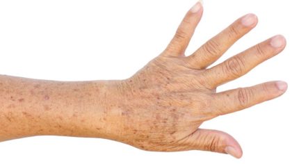 Taches sur les mains : causes et traitement