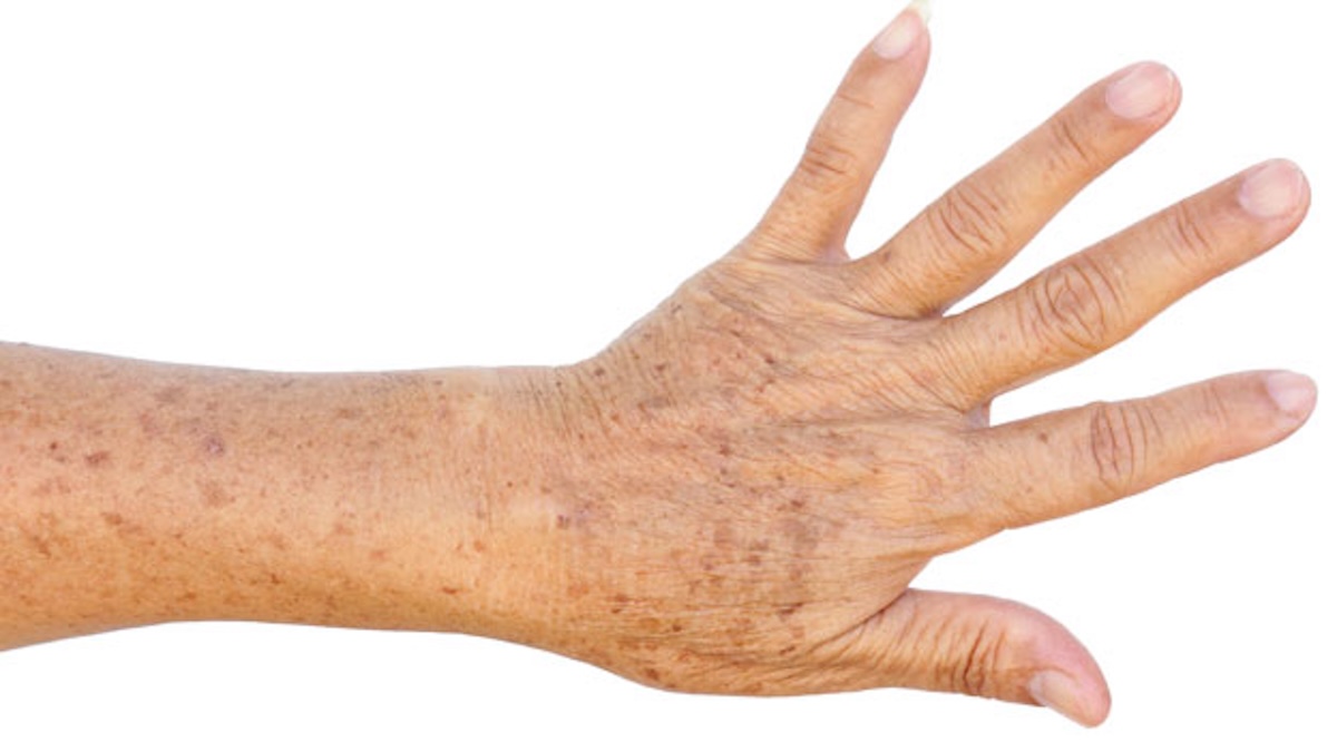 Taches sur les mains : causes et traitement