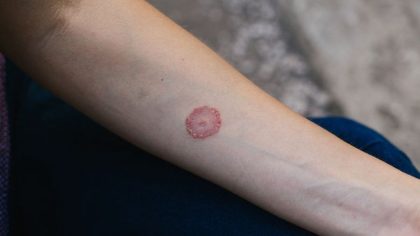 Tout ce que vous devez savoir sur la teigne du corps