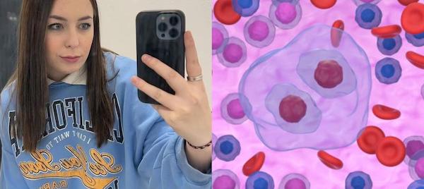 Une femme de 21 ans, diagnostiquée d'un cancer, révèle le symptôme inconnu qu'elle a ignoré