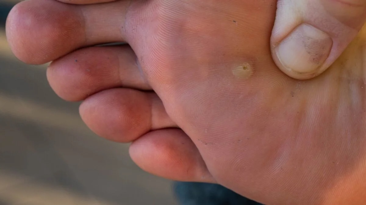 Verrues plantaires « yeux de poisson » : causes, symptômes et traitement