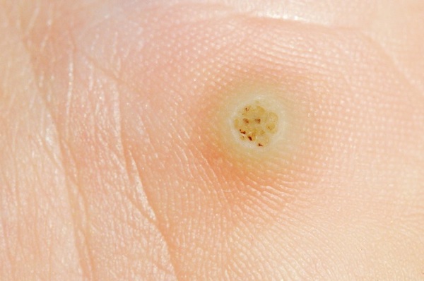Verrues plantaires « yeux de poisson » : causes, symptômes et traitement