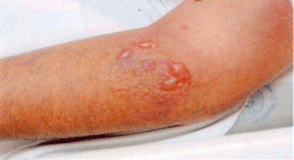 Vibrio vulnificus : infection, diagnostic et traitement