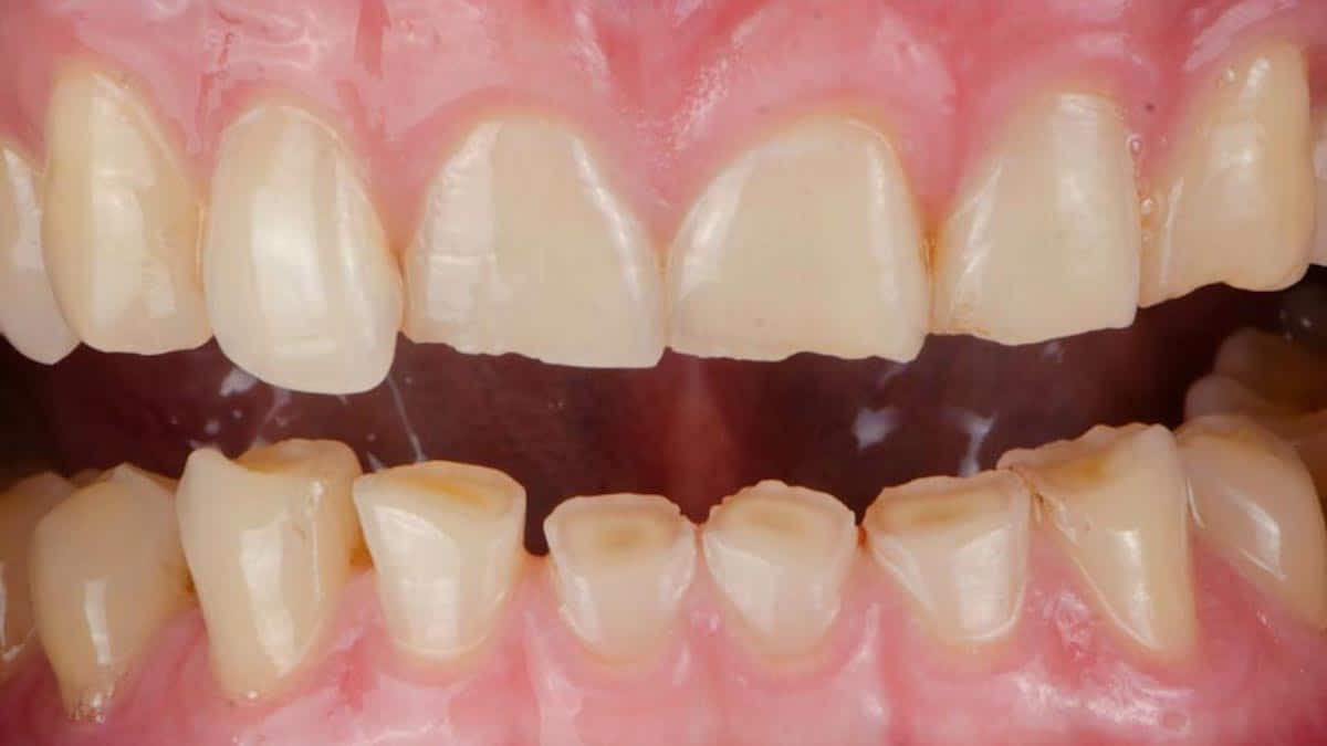 Qu'est-ce que l'abfraction dentaire et comment la traiter ?