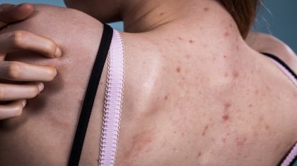 Acné du dos : causes, traitements et prévention