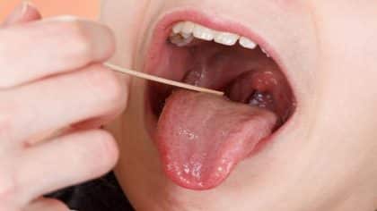 Amygdalite : symptômes et causes