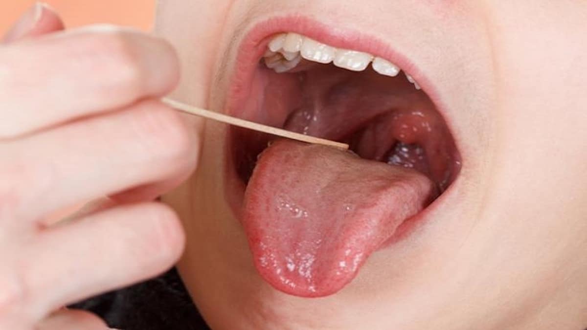 Amygdalite : symptômes et causes