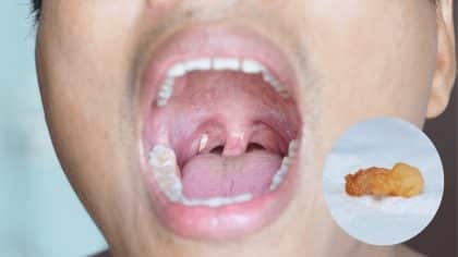 Amygdalites : que sont ces petites bosses blanches dans votre gorge ?