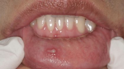 Infection au VPH : principaux symptômes et causes à connaître