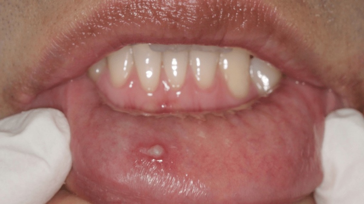 Infection au VPH : principaux symptômes et causes à connaître