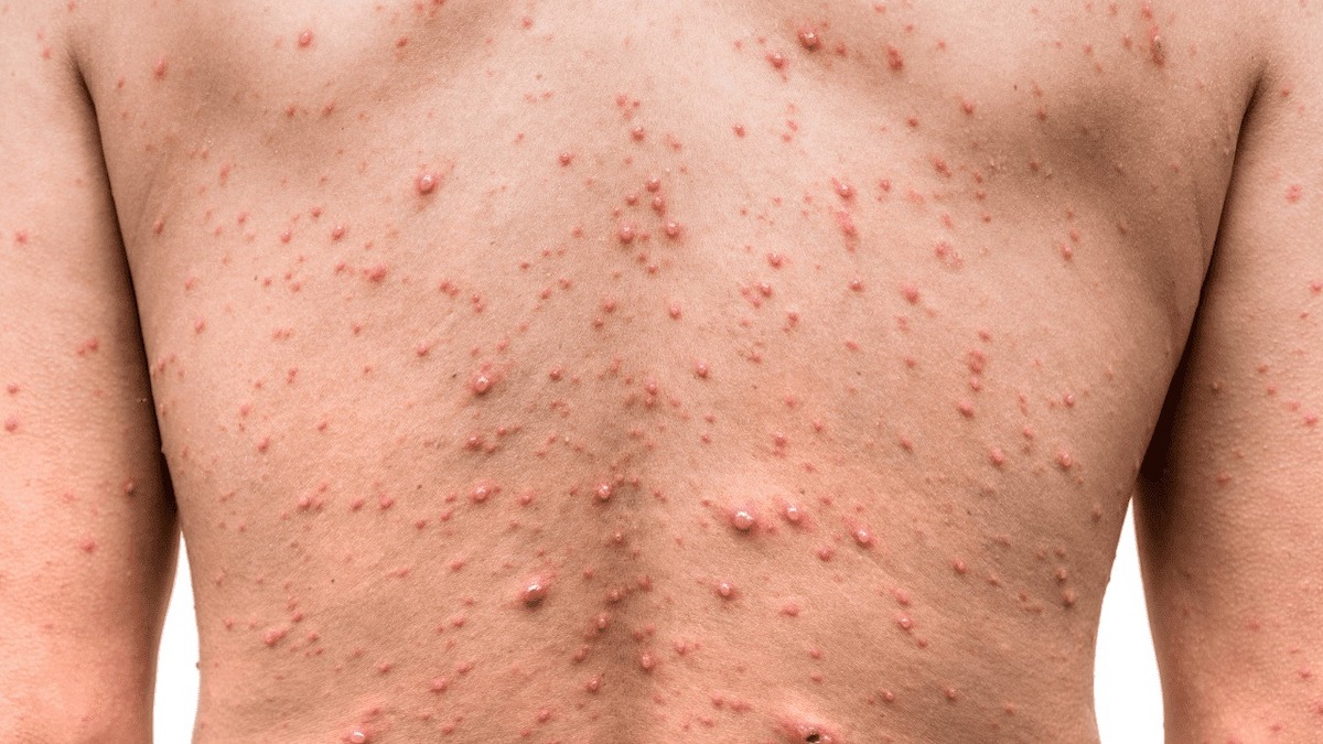 La variole du singe : quels sont les symptômes et que faut-il savoir sur l’éruption cutanée ?