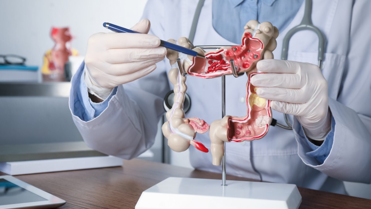 Les symptômes les plus étranges du cancer du côlon