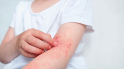 Empoisonnement, allergie ou éruption cutanée : comment les distinguer ?