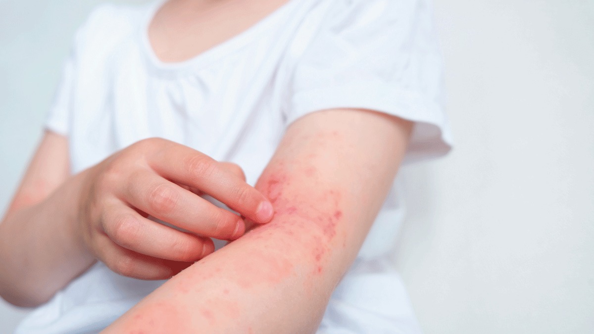 Empoisonnement, allergie ou éruption cutanée : comment les distinguer ?