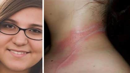 Gabbie Fedro, une adolescente américaine de 13 ans, a subi des brûlures au second degré à cause de son smartphone