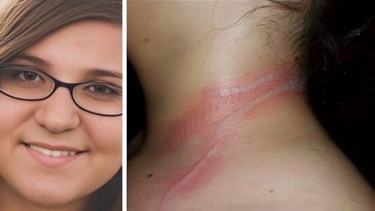Gabbie Fedro, une adolescente américaine de 13 ans, a subi des brûlures au second degré à cause de son smartphone