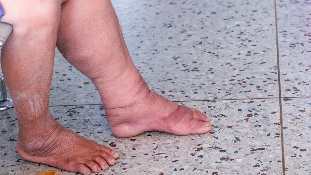 Mes jambes sont rouges et gonflées. Est-ce grave ? Un médecin répond