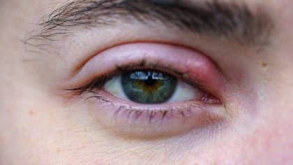 Orgelet à l’œil : 3 solutions maison pour s’en débarrasser rapidement