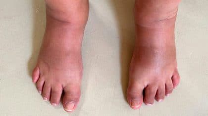 Pieds gonflés ? Causes, symptômes et solutions podologiques
