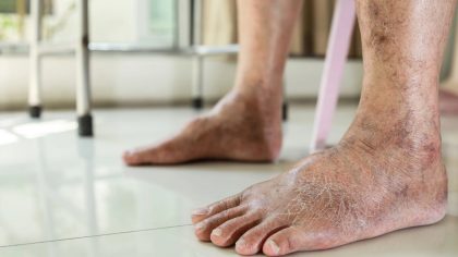 Pourquoi la couleur des jambes change : 5 raisons fréquentes