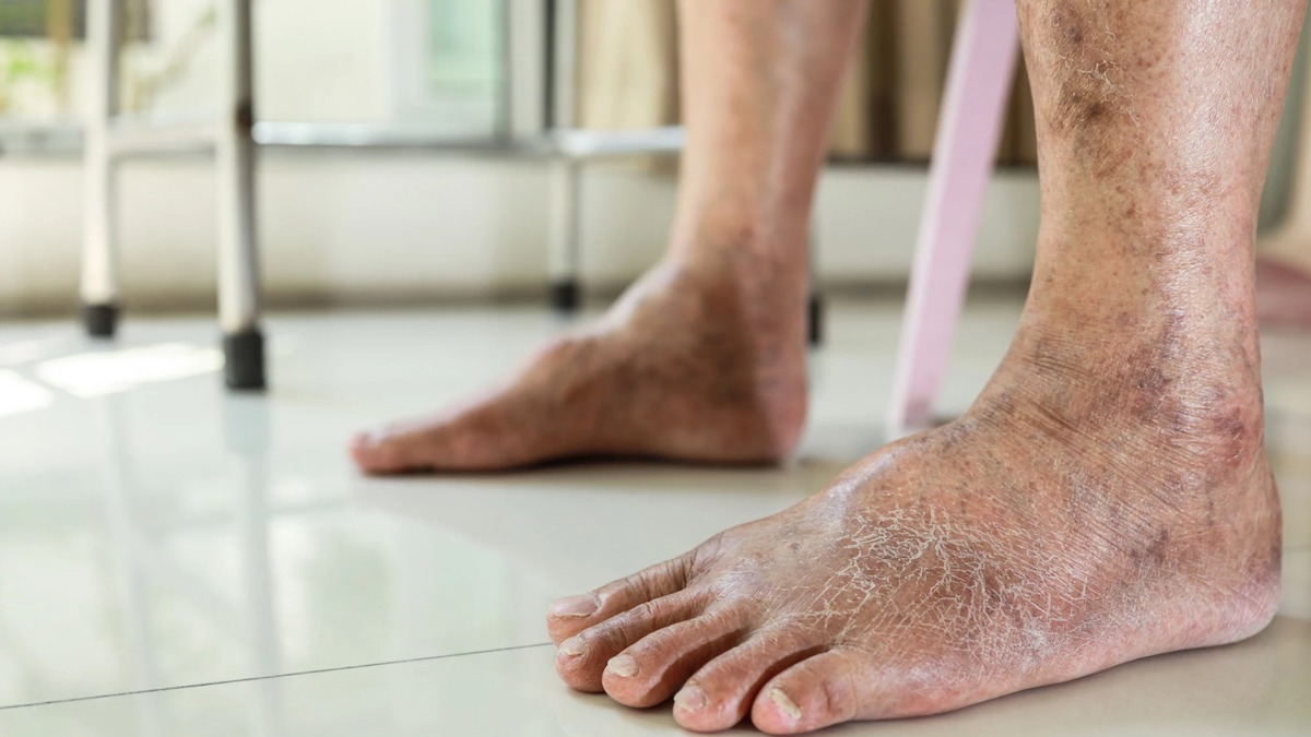 Pourquoi la couleur des jambes change : 5 raisons fréquentes