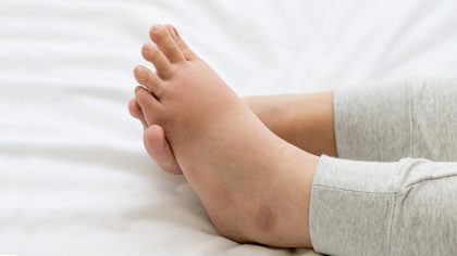 Pourquoi les chevilles gonflent-elles ? Les causes et les bons gestes pour les prévenir