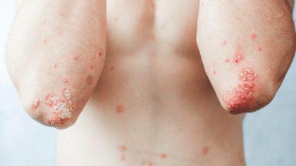 Psoriasis pustuleux : symptômes, causes et traitement