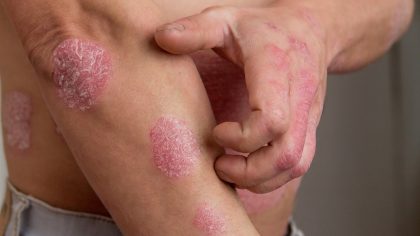 Psoriasis : tout ce que vous devez savoir sur cette affection cutanée