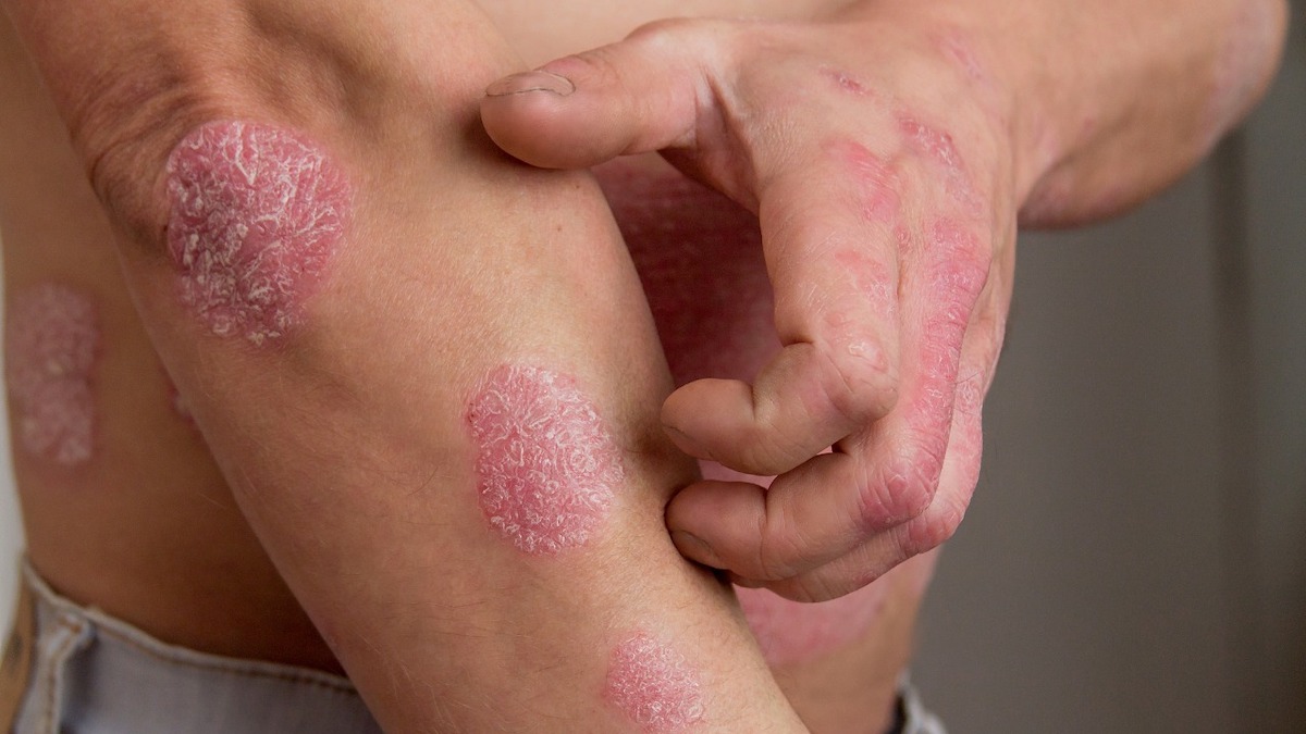 Psoriasis : tout ce que vous devez savoir sur cette affection cutanée